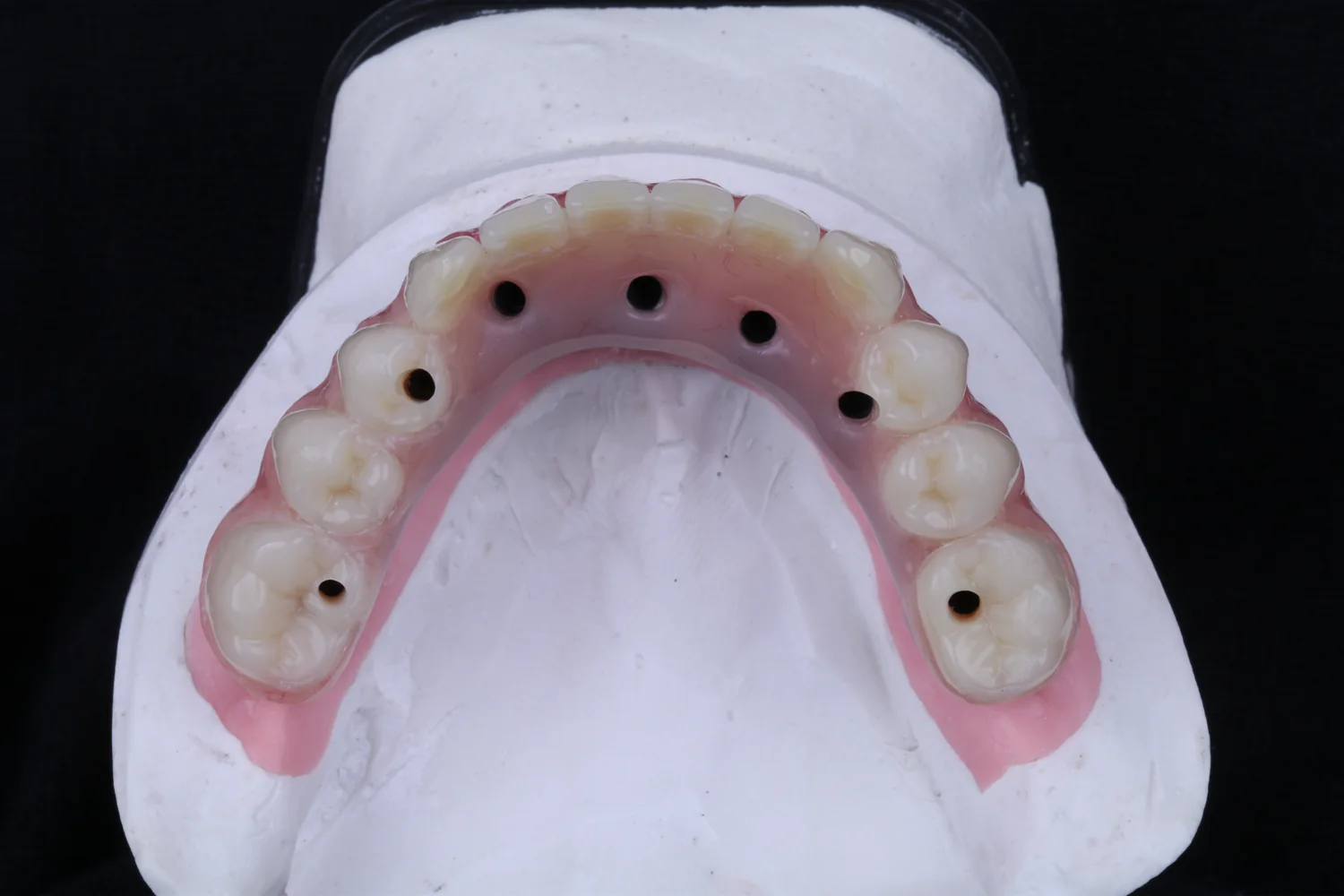 Prótese fixa sobre dentes e implantes